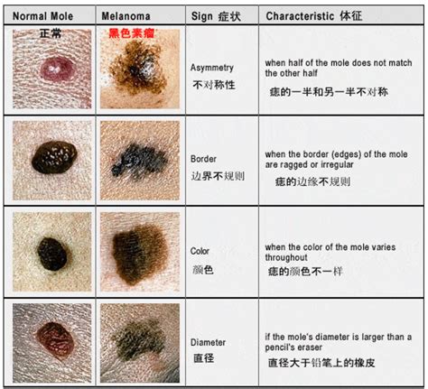 腰上长痣|痣也可能会癌变！长在 3 个地方要注意